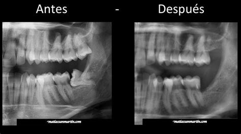 Lesi N De Caries Y Consecuencias Cl Nica Dental Sonr E