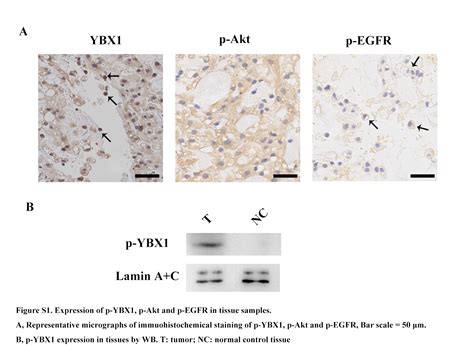 Y Box Binding Protein Promotes Tumorigenesis And Progression Via The