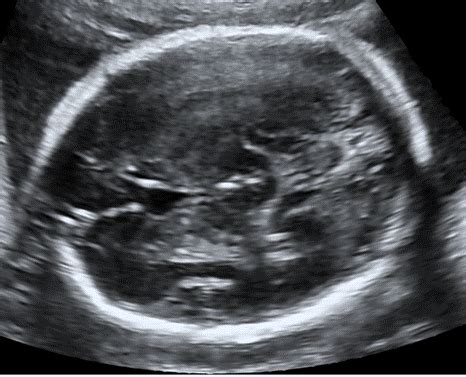 Advanced Fetal Neurosonography When Do I Need To Refer For Fetal MRI