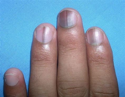 Melanonychia on Nails: Symptoms, Causes & Treatment