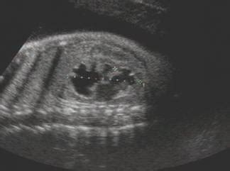 Classification Of Fetal Hydronephrosis