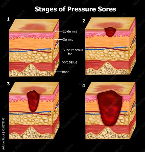 Stages Of Pressure Ulcers Sore Stages And Treatments Iransmarts