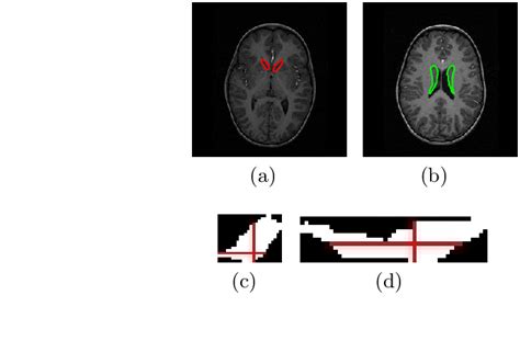 Example of (a) caudate head image, and (b) caudate body image, with ...