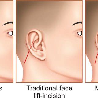 Modified Blair S Incision The Shaded Area Denotes The Site Of Parotid