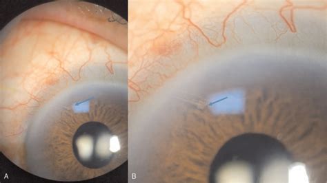 Recanalization Of XEN 45 Gel Stent Occlusion With Cortical Material