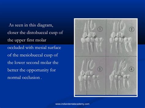 Andrews Six Keys Of Occlusion Certified Fixed Orthodontics Courses In