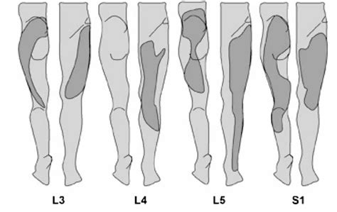 Sciatica: Referred or Radicular Pain? - OMNE Chiropractic