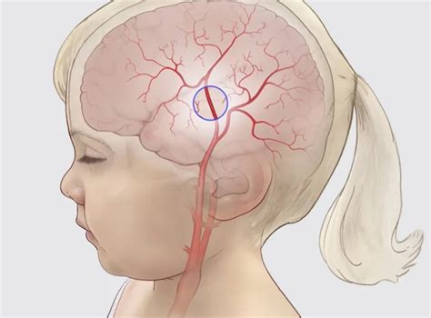 Moyamoya Disease Causes Symptoms And Treatment