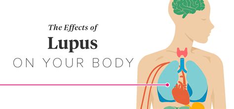 The Effects of Lupus on the Body