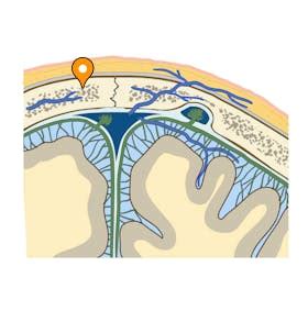 Arachnoid trabeculae - e-Anatomy - IMAIOS