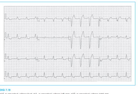 Ekg Ch Flashcards Quizlet