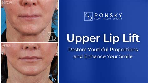 Upper Lip Lifts 101 Restore Your Youthful Smile