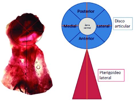 Visión inferior de disco articular y músculo pterigoideo lateral