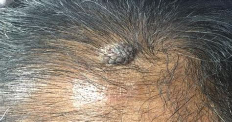 Wart On Scalp