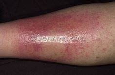 Cellulitis leg