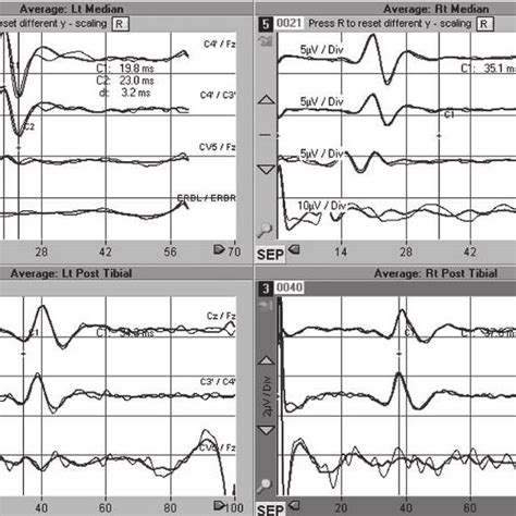 Somatosensory Evoked Potential Ssep Stack With Stable Cortical