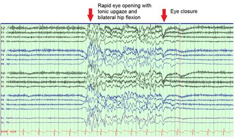 Burst suppression eeg - ekonaxre