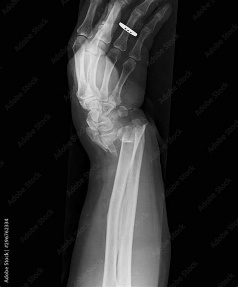 X Ray Image Of Wrist Jiont Lateral View Showing Distal Ulnar And