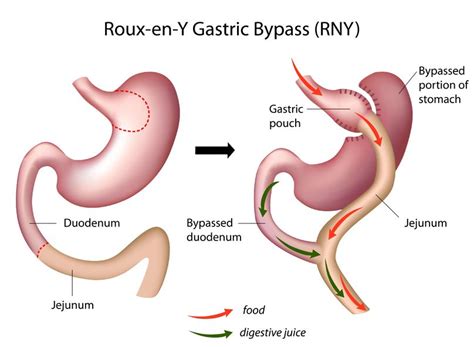 What Is Bypass Surgery Bariatric Surgery Riverhead Ny Obesity Treatment Commack Ny