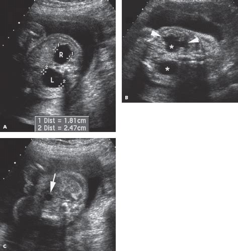 Genitourinary Tract Obgyn Key