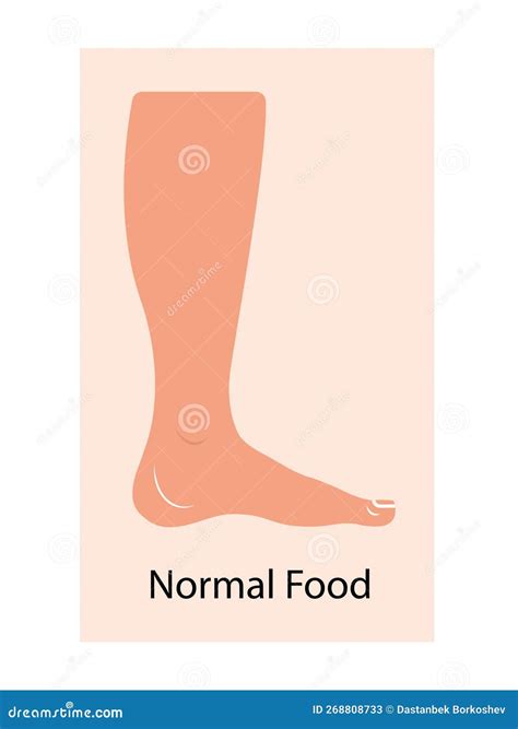 Lymphedema stages. stock illustration. Illustration of genetic - 268808733