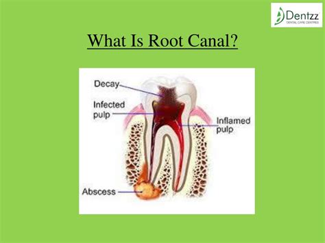 Ppt Painless Root Canal Treatment At Dentzz Powerpoint Presentation