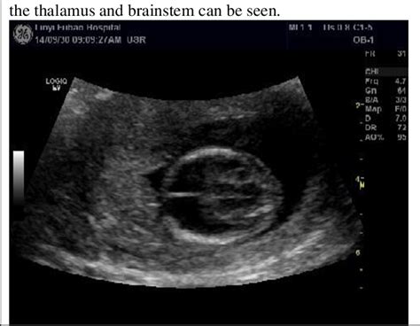 Figure 1 From The Ultrasonic Diagnosis And Differential Diagnosis Of