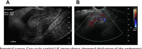 Figure 1 From Ultrasonography Evaluation Of Pelvic Masses Semantic