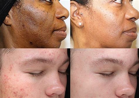 Chemical Peels — Phillips Aesthetic Dermatology