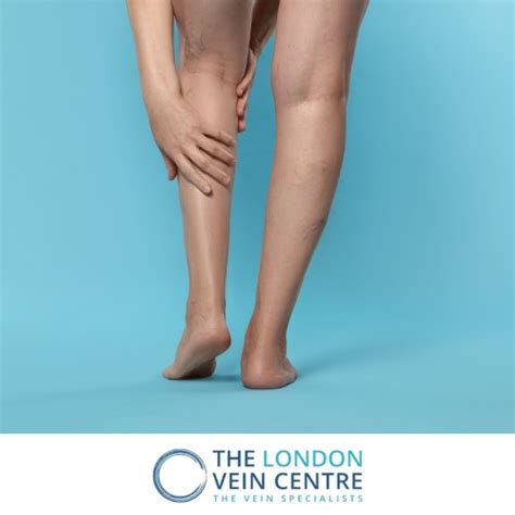 Do Creams Work For Leg Thread Veins Vein Treatment Centre