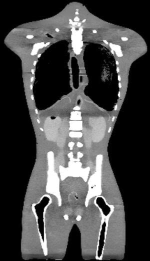 Torso Adulto Avanzado para Radiografía Tomografía Computarizada