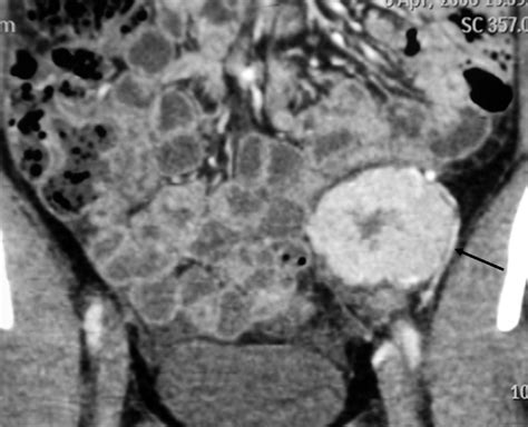 The Value Of Mdct In Diagnosis Of Hyaline Vascular Castleman S Disease