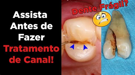 Tratamento De Canal Dentista Responde Dúvidas Sobre Canal No Dente