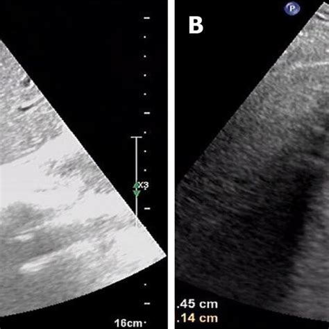 Abdominal Ultrasound Showed A Mixed Echogenic Mass In The Right Lobe Of Download Scientific