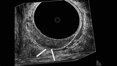 Three Dimensional Erus Of T1 Rectal Cancer The Arrows Show The