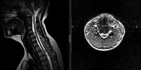 Preoperative MRI demonstrating herniated disc at C5-6. | Download ...