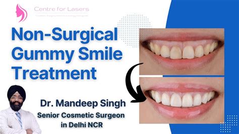 Best Non Surgical Gummy Smile Treatment L Non Surgical Gummy Smile