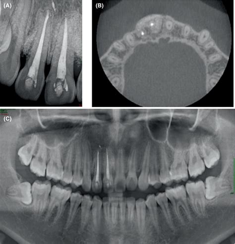 Radiographs 7 Years Postsurgery A Bone Graft Filling At The Bone