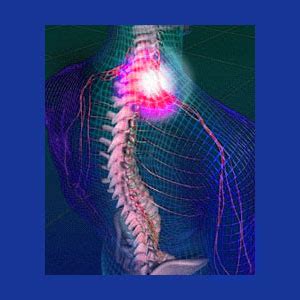 pinched-cervical-nerve-51 - Neck Pain