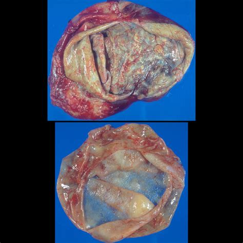 Pediatric Hydatid Disease | Pediatric Radiology Reference Article | Pediatric Imaging | @pedsimaging