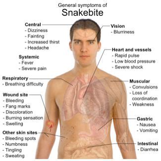 First Aid Snake Bite - Health Safety & Environment