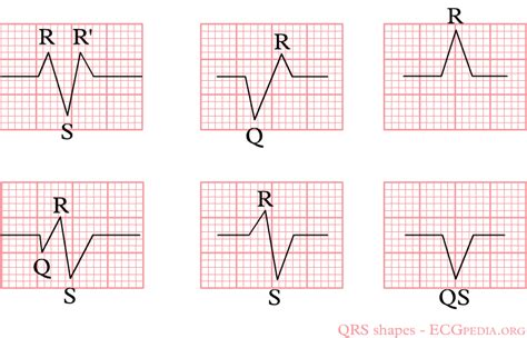 QRS complex - wikidoc