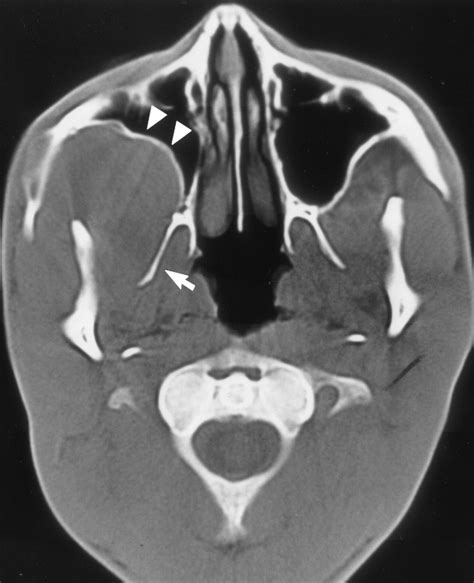 Neuroradiology Case Of The Day RadioGraphics