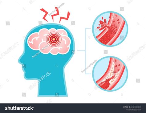 Human Head Brain Stroke Disease Atherosclerosis Stock Vector (Royalty ...