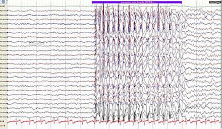 Ny Viden Om Prognose For Og Behandling Af B Rneabsenceepilepsi