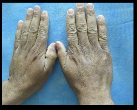 A-psoriasis patient before treatment, B-psoriasis patient after ...