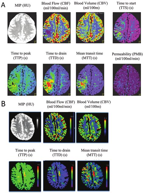 Whole Brain Ctp With Perfusion Deficits In The Middle Cerebral Artery