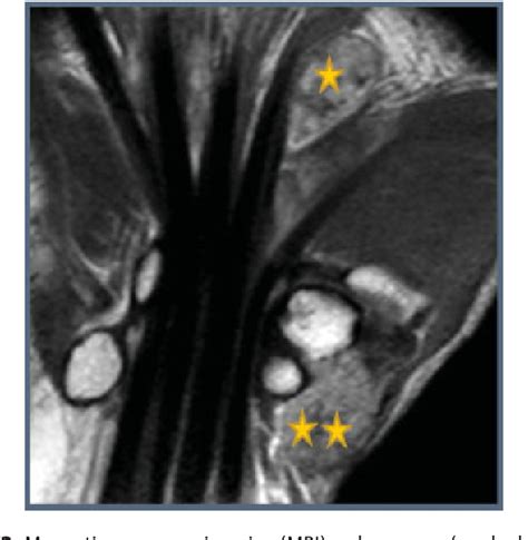 Figure From Extended Pigmented Villonodular Synovitis Of The Hand