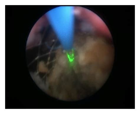 Image From The Semirigid Ureterorenoscopy With Laser Lithotripsy