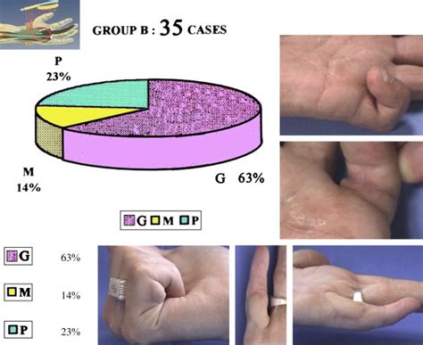 A Fresh Look At Vascularized Flexor Tendon Transfers Concept